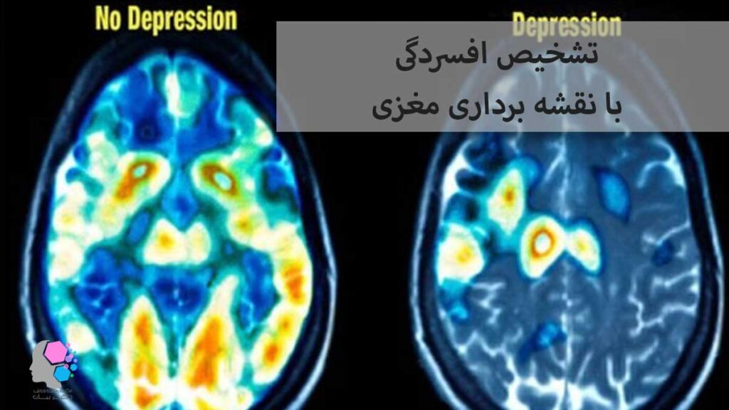 تشخیص افسردگی با نقشه برداری مغزی