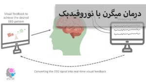 درمان میگرن با نوروفیدبک